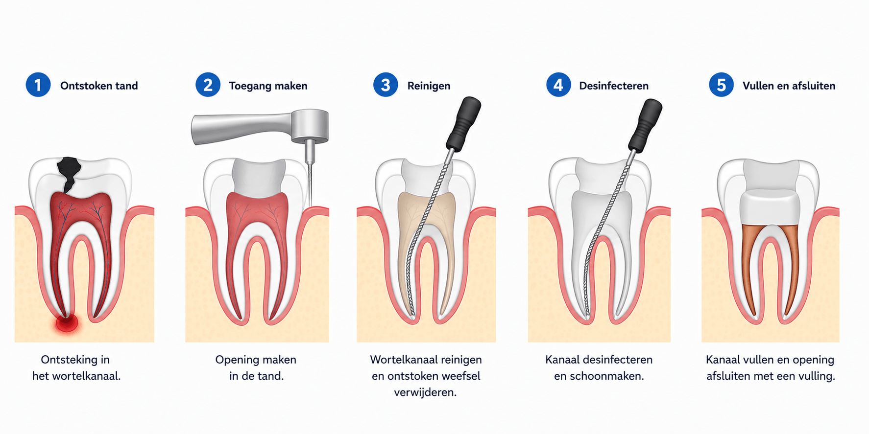 Illustratie van een wortelkanaalbehandeling